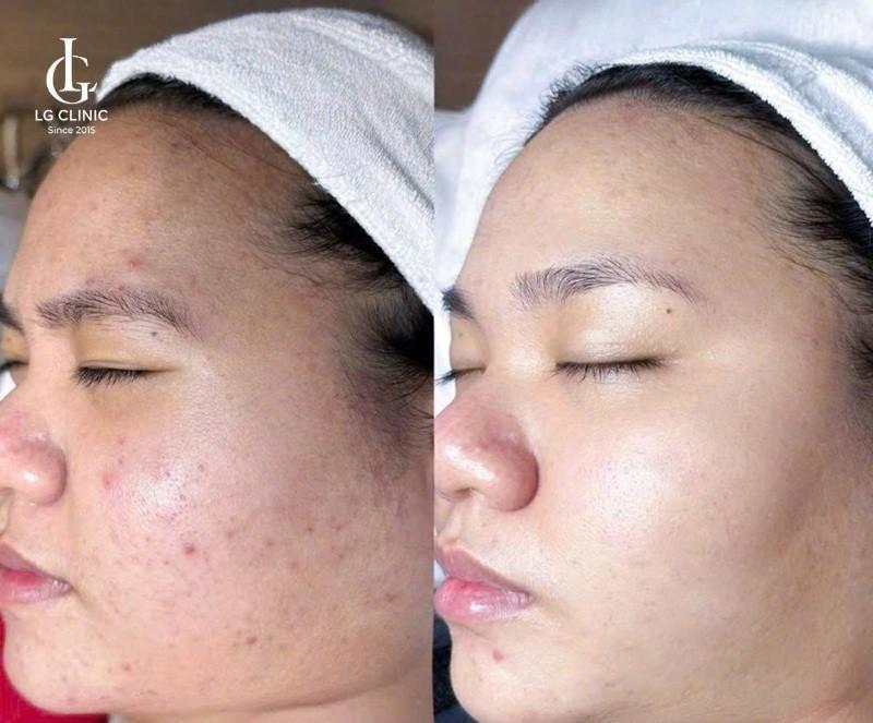 Kết quả điều trị mụn thâm đỏ tại LG Clinic