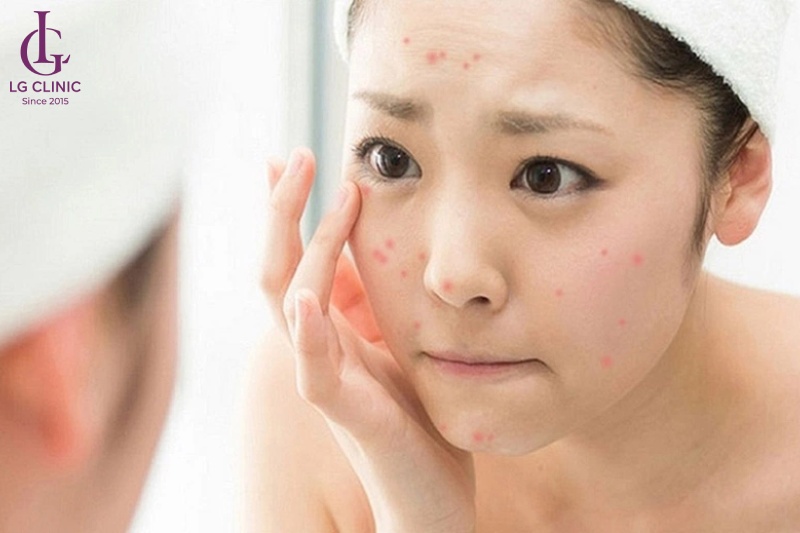 nguyên nhân tăng sắc tố sau viêm