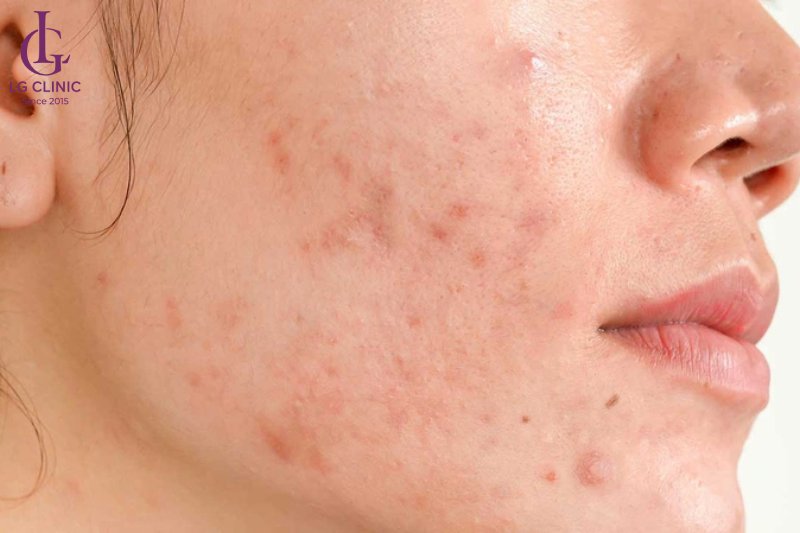 mụn thâm đỏ gây tư ti