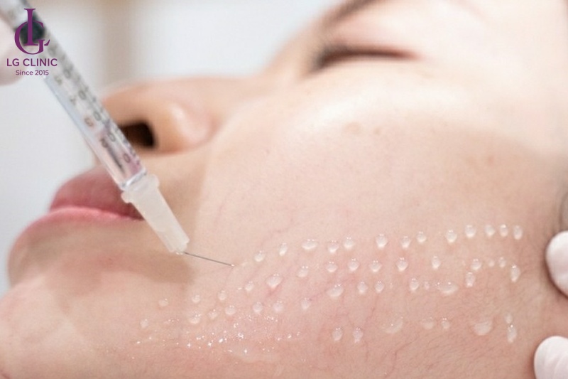 tiêm meso để trị thâm đỏ sau mụn