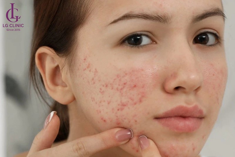thâm mụn đỏ có 3 mức độ