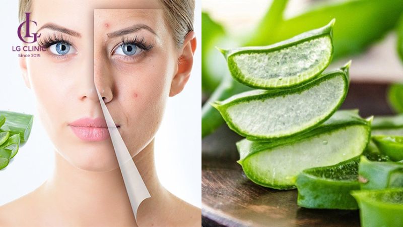 dùng nha đam trị thâm mụn cấp tốc sau 1 đêm
