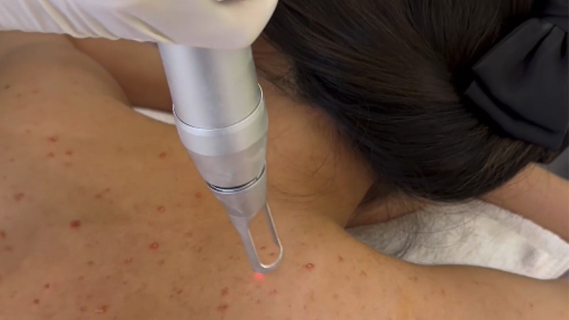 cách trị thâm mụn lưng