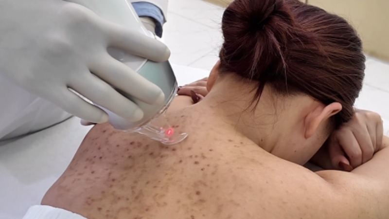 cách trị thâm mụn lưng