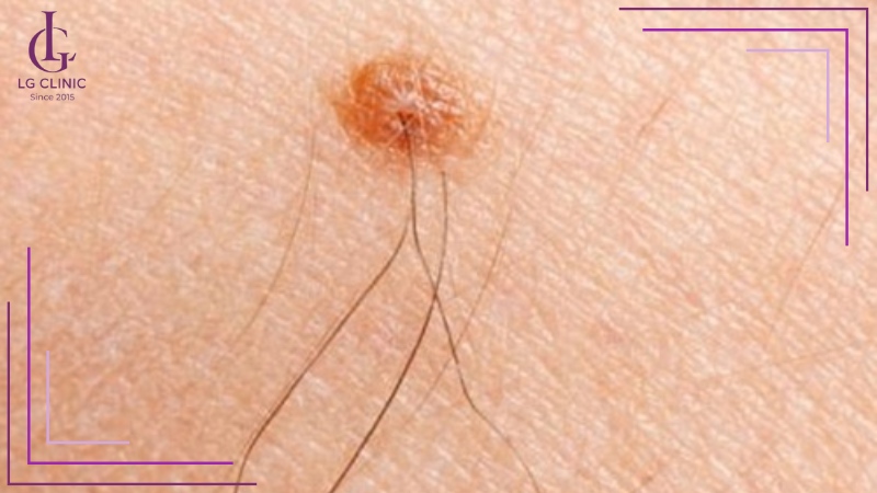 Lông tài mọc trên nốt ruồi ở cổ