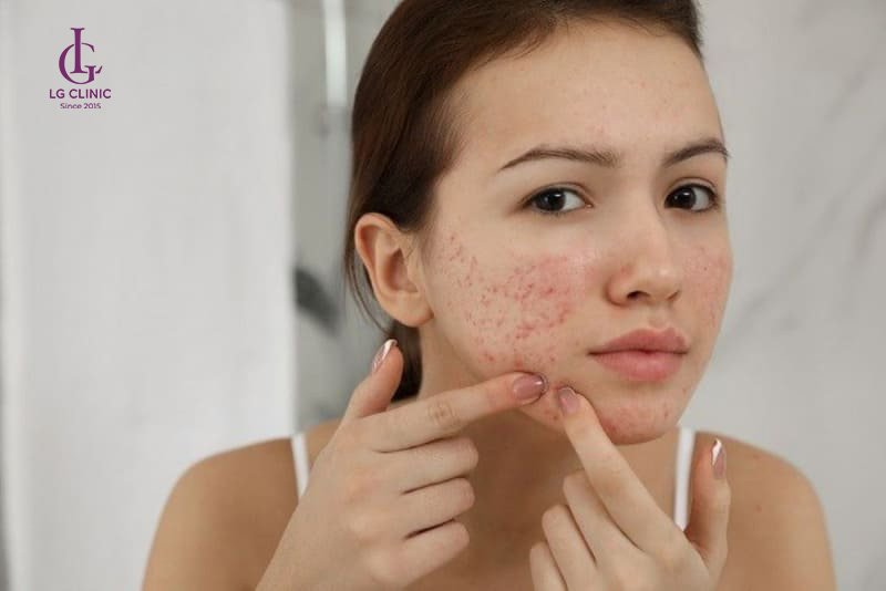 Mụn thâm tụ máu trên mặt