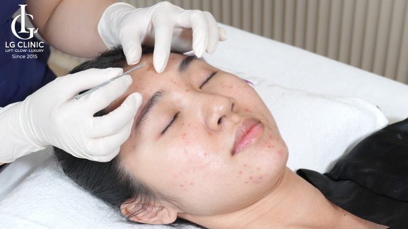 nặn mụn xong nên làm gì để không bị thâm