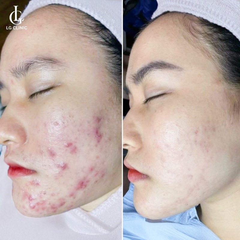 nặn mụn xong nên làm gì để không bị thâm