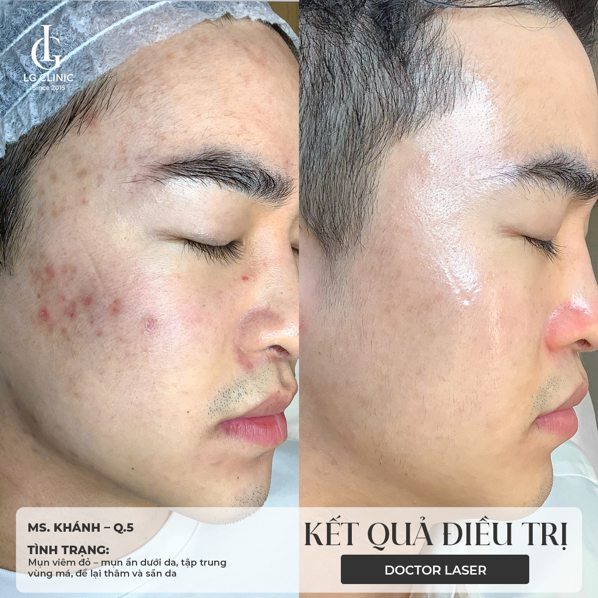 nặn mụn xong nên làm gì để không bị thâm