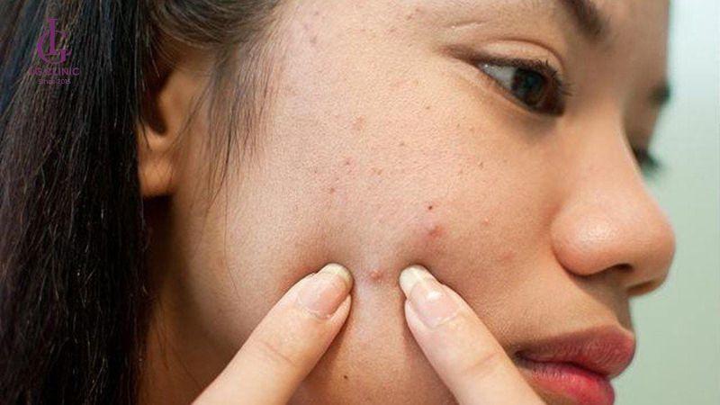 tự ý nặn mụn nên gây ra thâm mụn