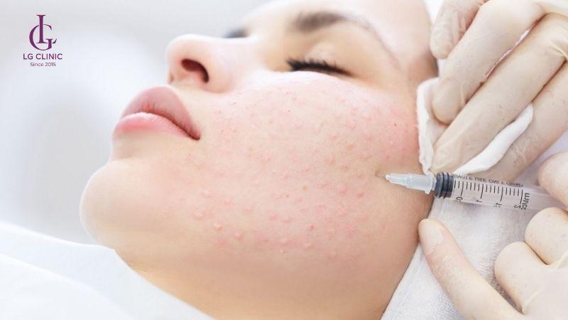 tiêm meso để trị vết thâm mụn mãi không hết