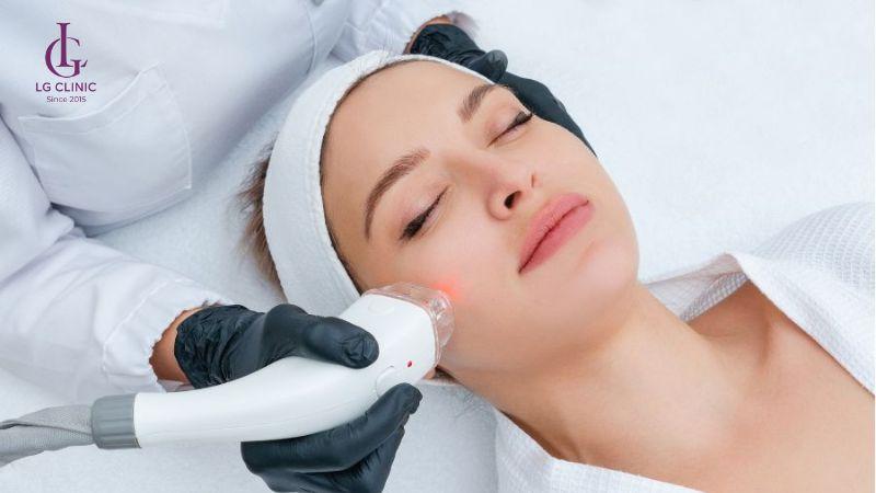 xóa thâm mụn bằng laser