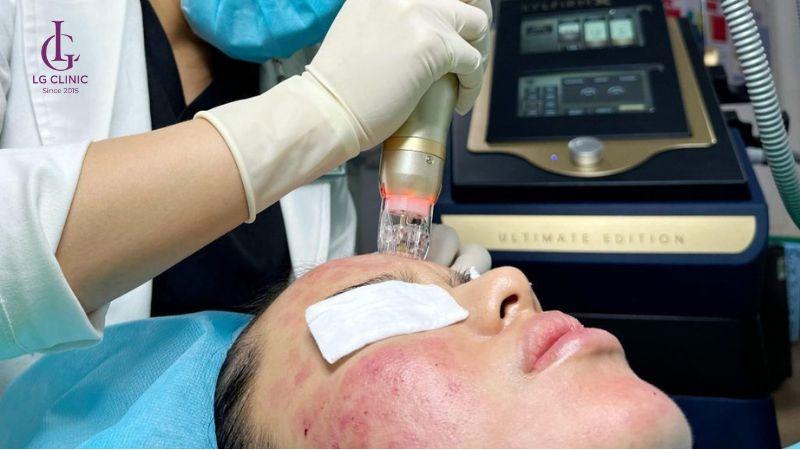 công nghệ RF siêu vi điểm