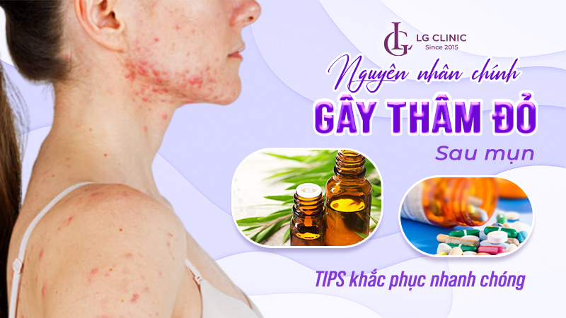 cách trị thâm đỏ sau mụn