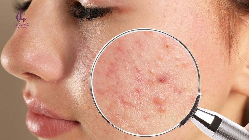 chăm sóc da sẽ là yếu tố để thâm mụn bao lâu thì hết