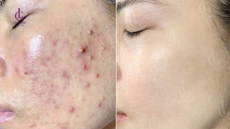 điều trị thâm mụn tại lg clinic