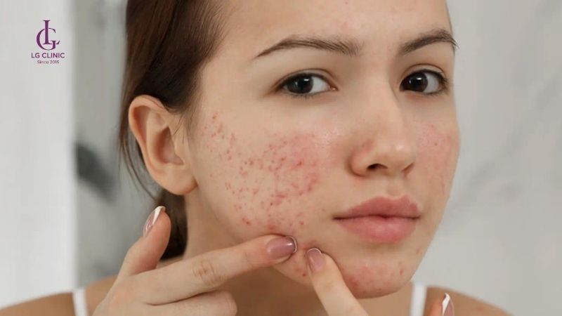 trị mụn vẫn bị thâm sau mụn
