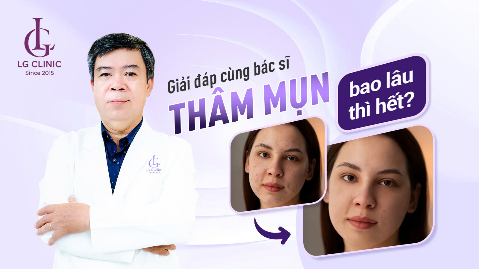 thâm mụn bao lâu thì hết