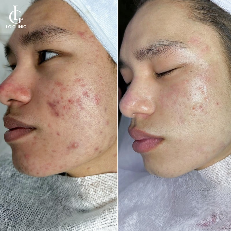 cách trị thâm đỏ sau mụn