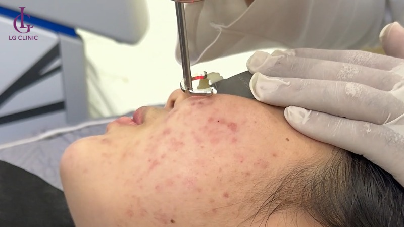 cách trị thâm đỏ sau mụn