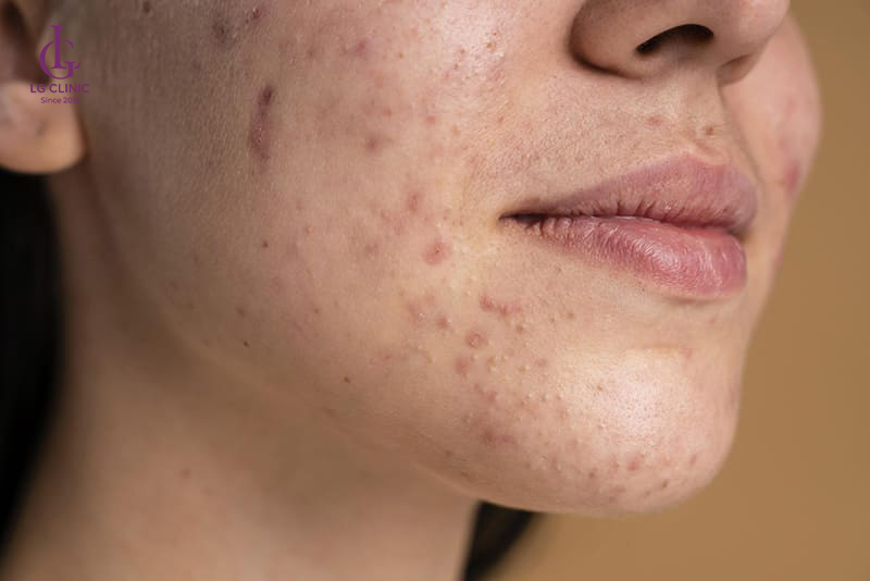 Da mặt bị thâm mụn
