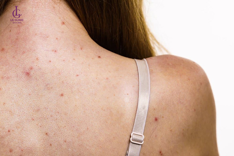 Mụn lưng do gội đầu không đúng cách