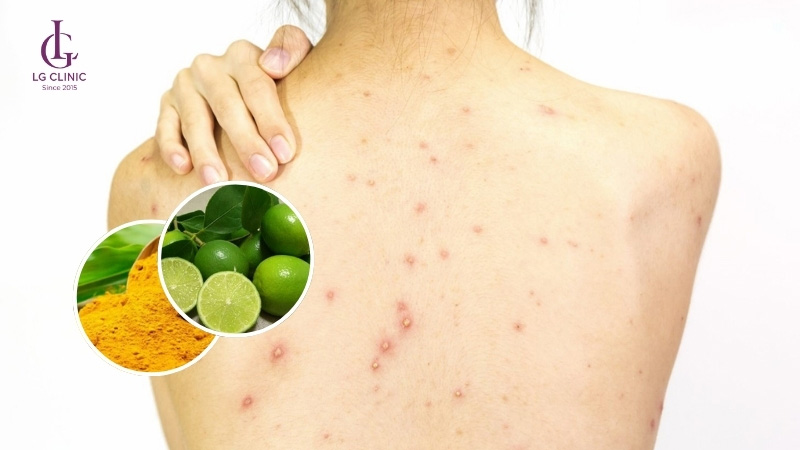 Trị thâm mụn lưng bằng nguyên liệu từ thiên nhiên
