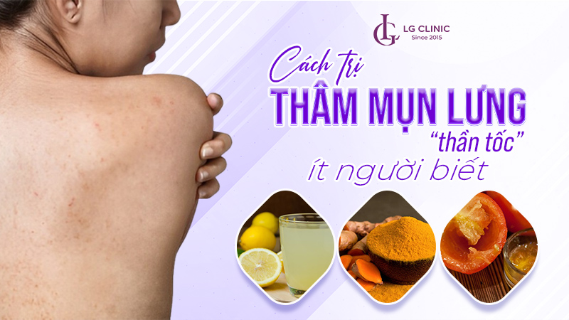 Trị thâm mụn lưng