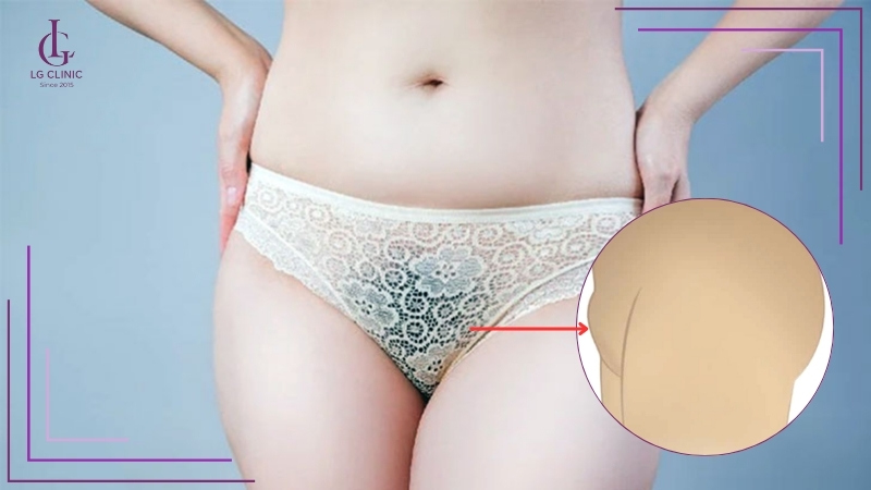 Xương mu nhô cao có kèm lông rậm