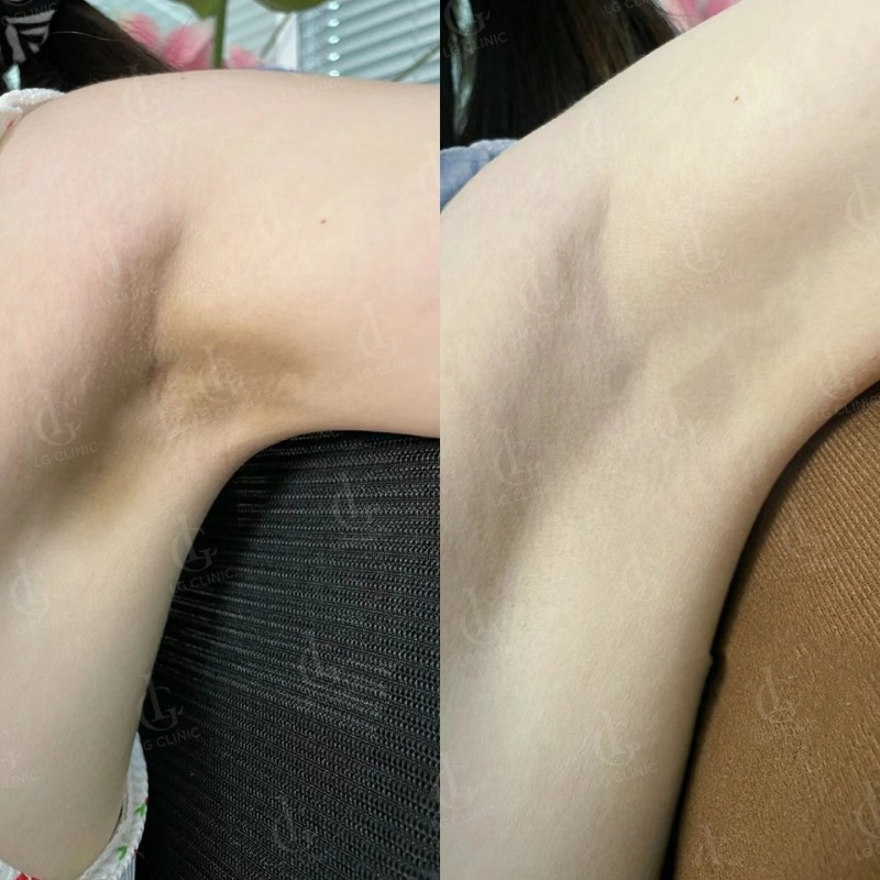 spa trị thâm ở tân bình