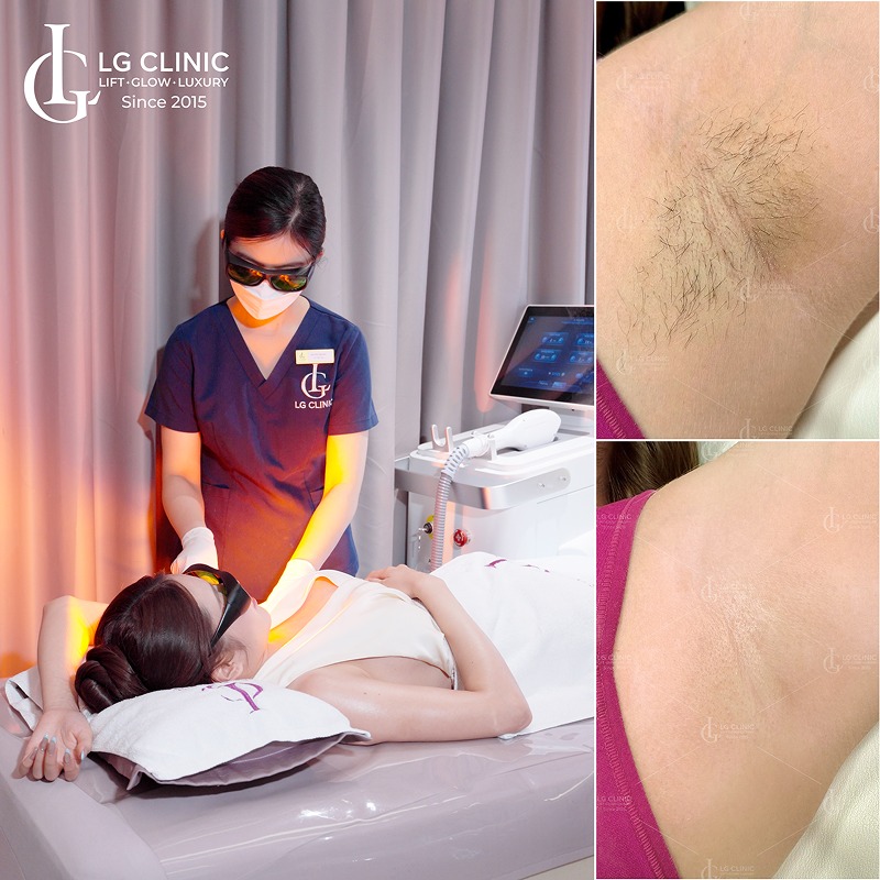 thẩm mỹ triệt lông nách