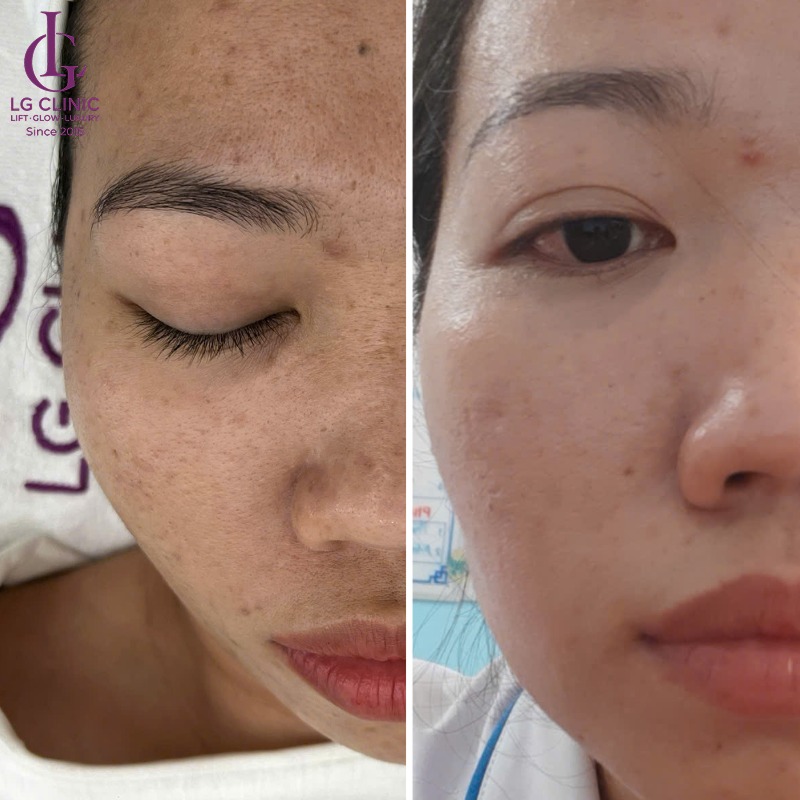cách trị thâm mụn bằng rau diếp cá