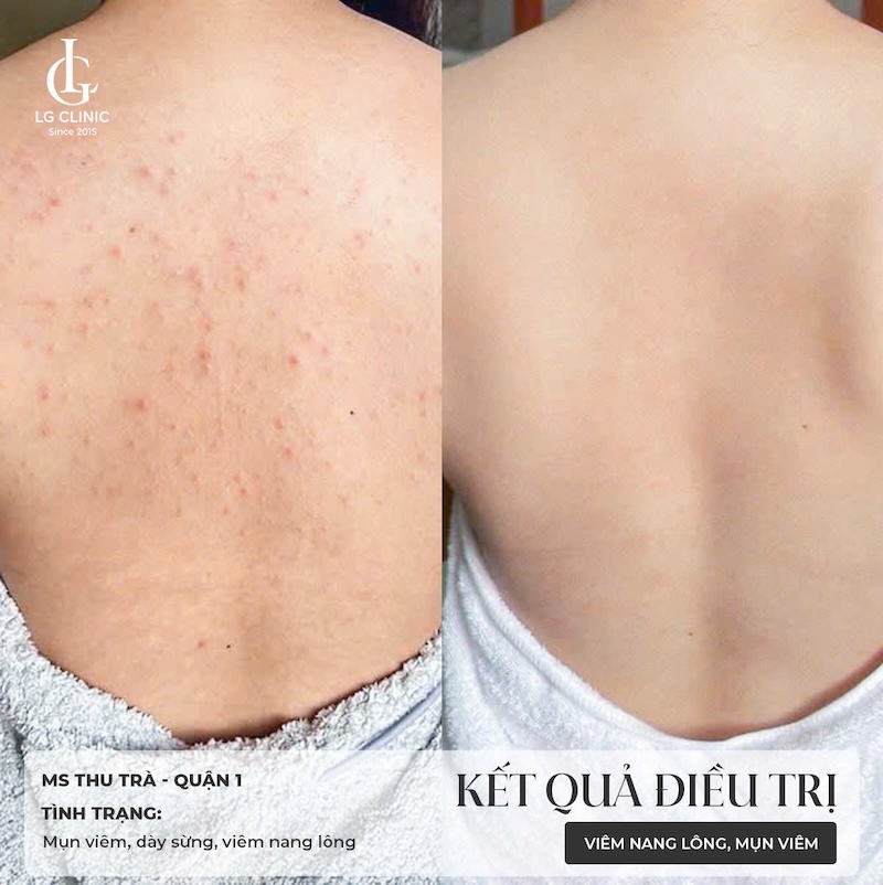 trị viêm nang lông