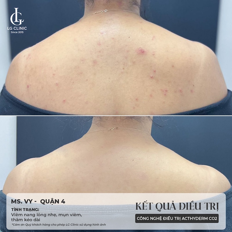 trị viêm nang lông