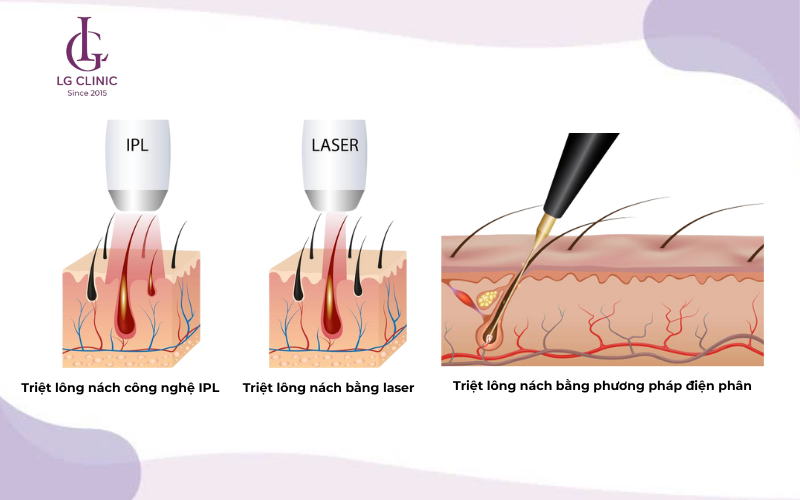 Triệt lông nách