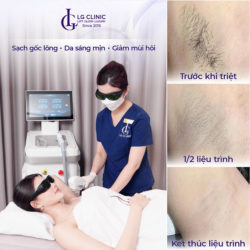 cách triệt lông nách tại nhà