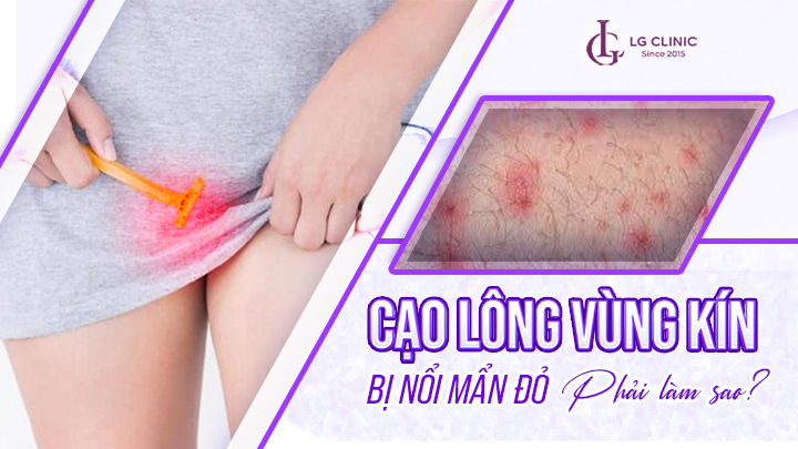 Cạo lông vùng kín bị nổi mẩn đỏ