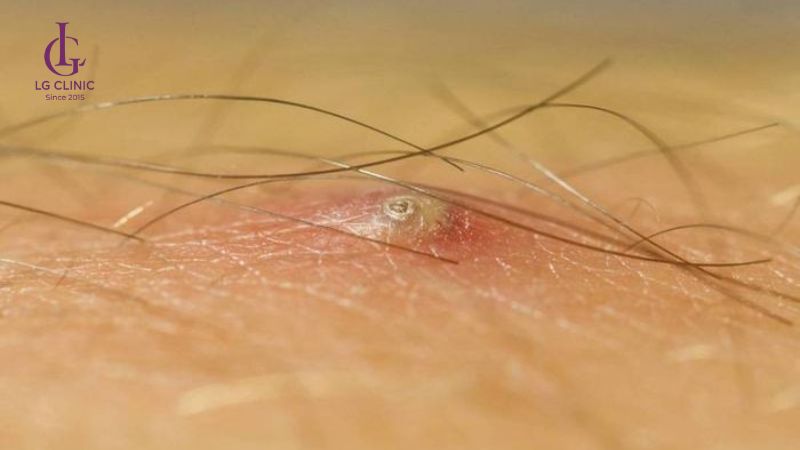 cắt tỉa lông vùng kín nam giới có thể bị lông mọc ngược