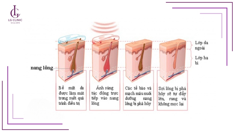 Cơ chế tác động của liệu trình triệt lông vĩnh viễn