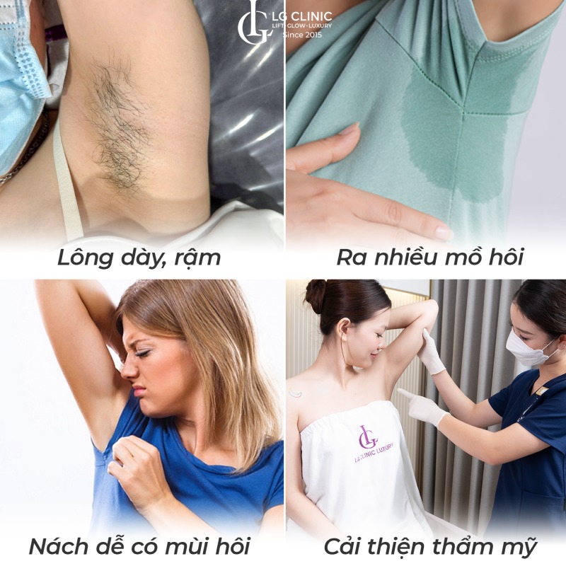 triệt lông nách vĩnh viễn