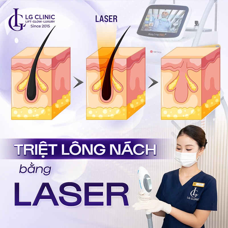 triệt lông nách vĩnh viễn