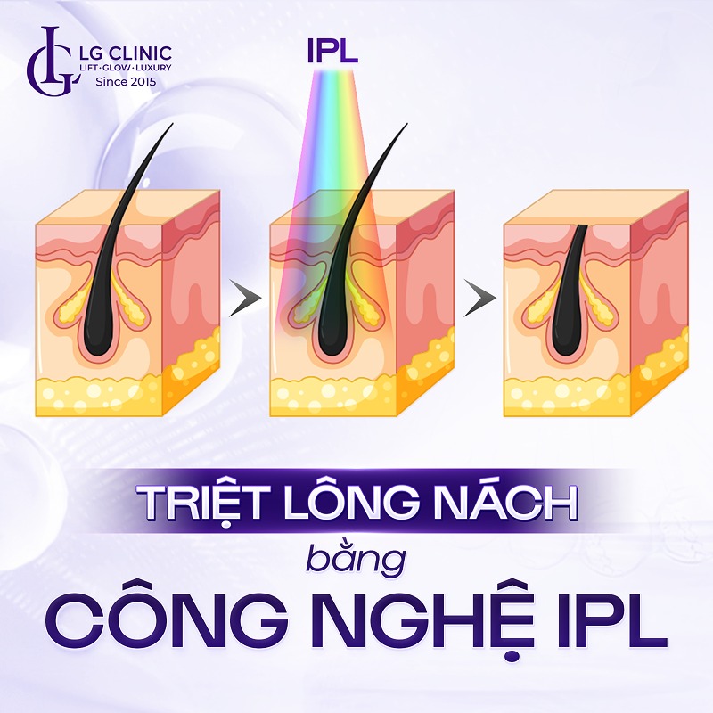 triệt lông nách vĩnh viễn
