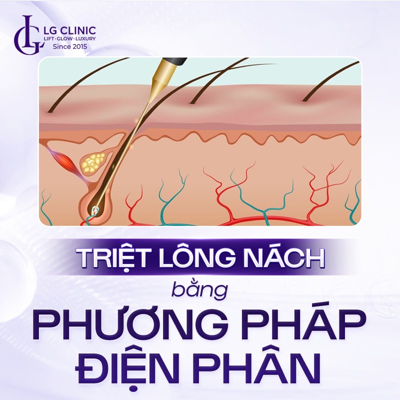 triệt lông nách vĩnh viễn