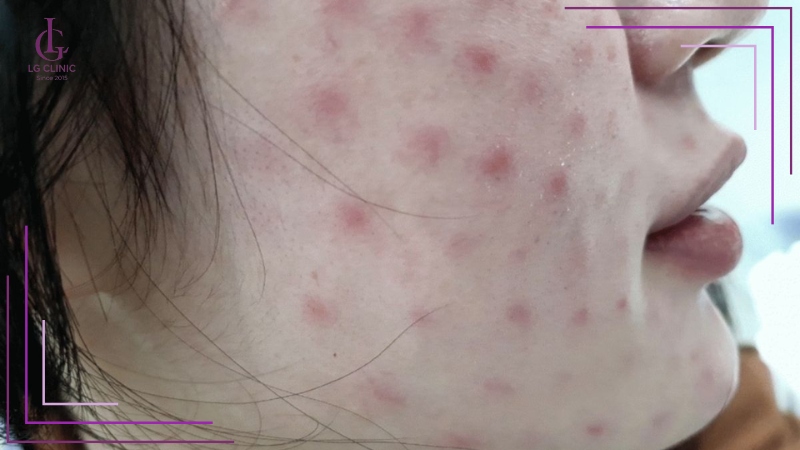 Biến chứng u hạt trên da