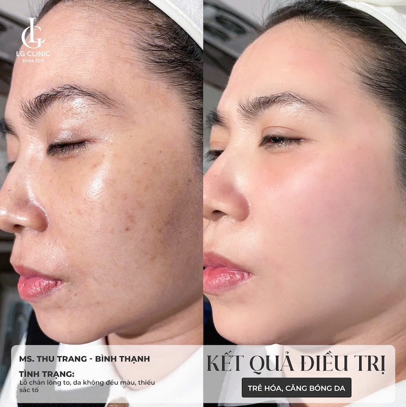kết quả sau khi tiêm Karisma Rh Collagen 2