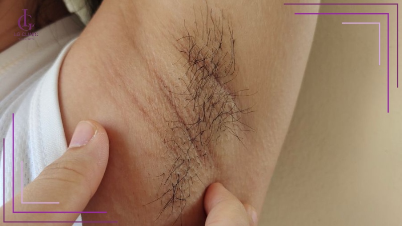 Bảng liệu trình triệt lông vĩnh viễn theo từng vùng da