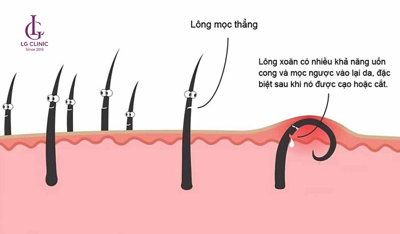 Lông mọc ngược là tình trạng phổ biến gây ngứa và viêm da