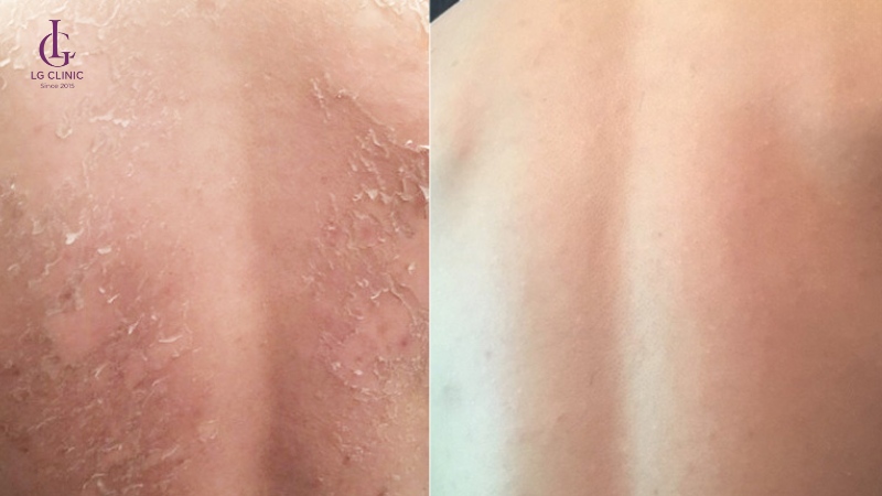 peel da trị mụn lưng