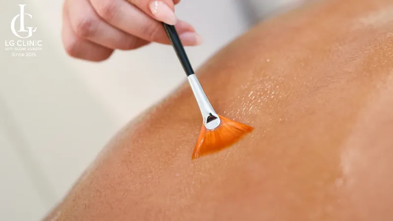 Peel mụn lưng có tốt không