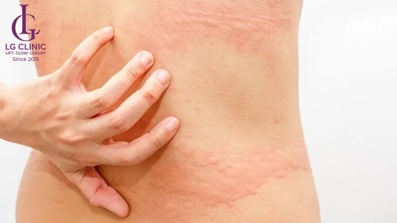 Peel mụn lưng có tốt không